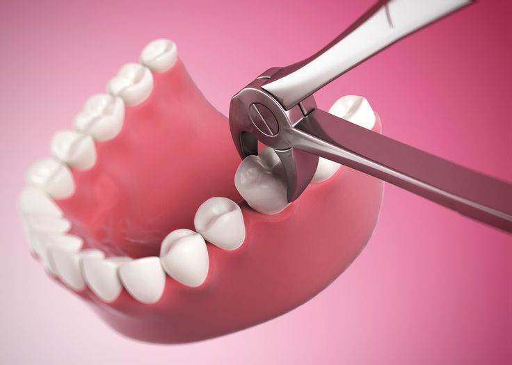 Dental Extraction Treatment